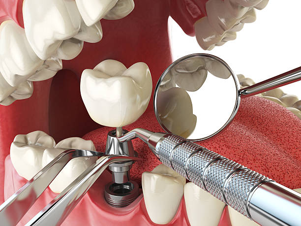 Best Emergency Dental Care for Broken or Chipped Teeth in Lyons, KS