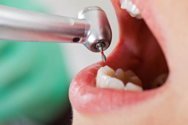 Best Emergency Treatment for Dental Infections or Abscesses in Lyons, KS